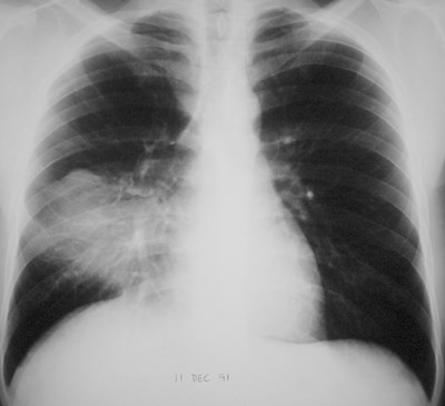 G:\photos\infection\Tuberculosis\primary TB RML consol\pa  .JPG